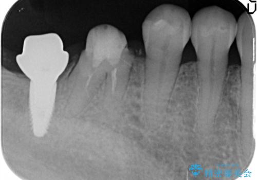 咬合機能を回復する奥歯のインプラント治療の治療中