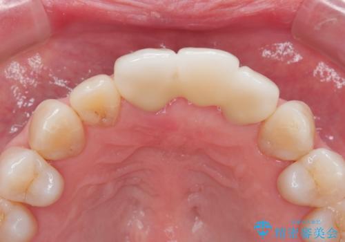 [ 欠損部の著しい骨欠損 ]　歯ぐきのボリュームを回復し自然なブリッジ作製治療の治療後