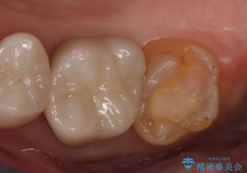 銀歯をやり変えたい　セラミックインレーの治療中