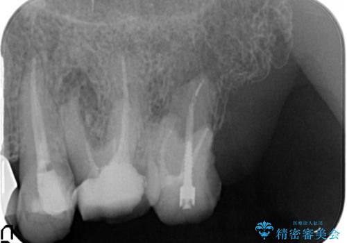 歯ブラシのしやすいクラウンへのやりかえの治療前