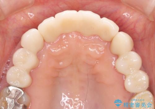 [ 再生療法 ]  歯周病治療を行った前歯のセラミック治療の治療後