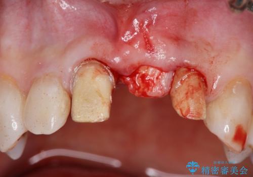 [ 欠損部の著しい骨欠損 ]　歯ぐきのボリュームを回復し自然なブリッジ作製治療の治療中
