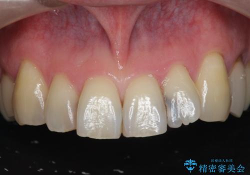 前歯の歯間に発生した虫歯のセラミック治療の症例 治療前