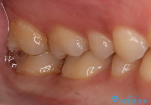 奥歯を良いもので治したい セラミックインレーの治療後