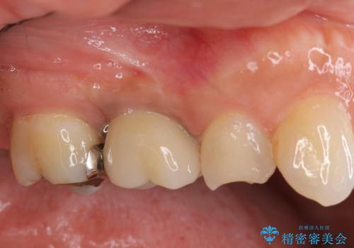 [ 奥歯の欠損 ] インプラントを用いた咬合機能の回復の症例 治療後