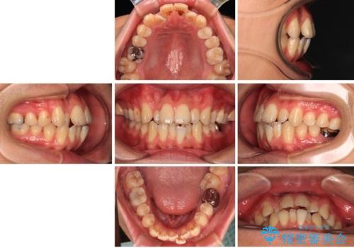 口が閉じにくい原因を根本から改善|上下顎4本抜歯による矯正治療症例の治療前