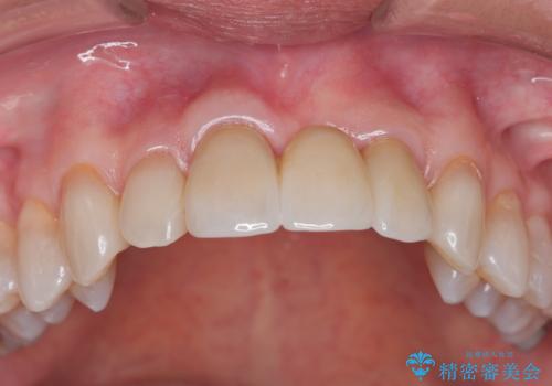 [ 欠損部の著しい骨欠損 ]　歯ぐきのボリュームを回復し自然なブリッジ作製治療の治療後