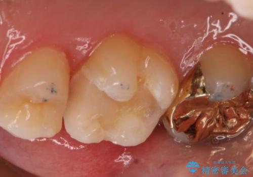 銀歯を金歯にしたい　ゴールドインレーの治療中