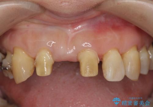 [ 再生療法 ]  歯周病治療を行った前歯のセラミック治療の治療中