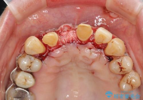 [ 再生療法 ]  歯周病治療を行った前歯のセラミック治療の治療中