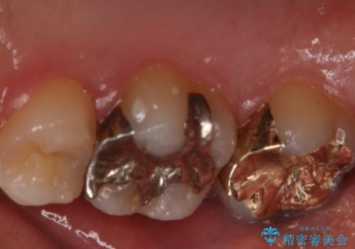 銀歯を金歯にしたい　ゴールドインレーの治療前
