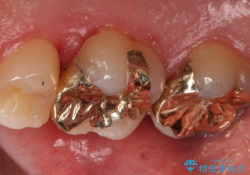 銀歯を金歯にしたい　ゴールドインレーの治療後