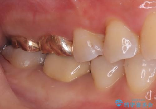 【セラミックインレー】歯の奥側に虫歯ができてしまったの治療後