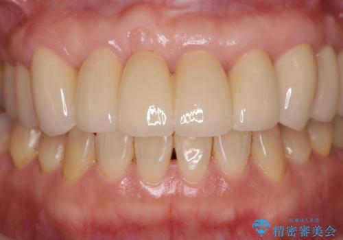[ 再生療法 ]  歯周病治療を行った前歯のセラミック治療の治療後