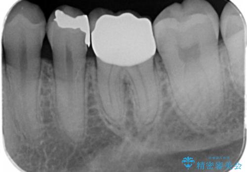 [ セラミック治療 ]  清掃性の悪い修復物を改善の治療後
