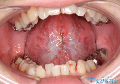 【舌小帯切除】ら行が言いづらいの治療中