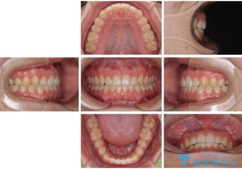すきっ歯は放置NG?インビザラインで目立たず改善の治療後