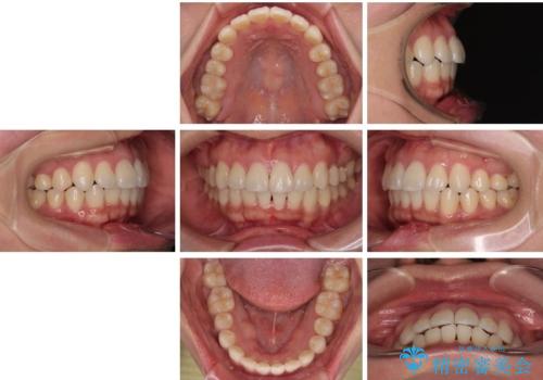 デコボコと正中のずれを改善した矯正治療の治療後
