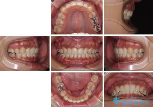 抜歯矯正で口が閉じやすく|ディープバイトと叢生を改善した症例の治療後
