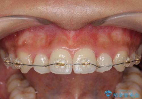 前歯のねじれ、すれ違いを改善 部分ワイヤー+マウスピース矯正の治療前