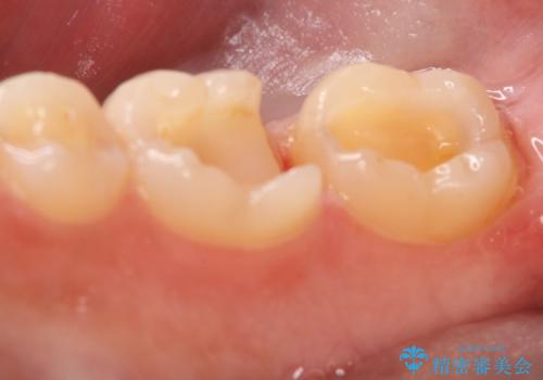 奥歯を良いもので治したい　セラミックインレーの治療中