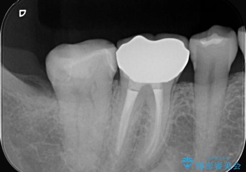 【セラミックインレー】歯の奥側に虫歯ができてしまったの治療後