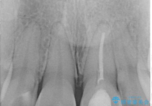 前歯の気になる変色を解消。再根管治療とオールセラミックで自然な美しさへの治療前