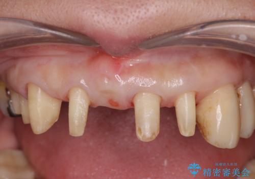 [ 再生療法 ]  歯周病治療を行った前歯のセラミック治療の治療中