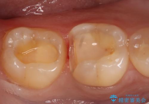奥歯を良いもので治したい　セラミックインレーの治療中