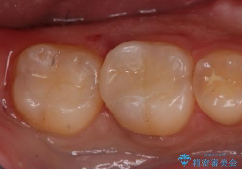 奥歯を良いもので治したい セラミックインレーの治療後