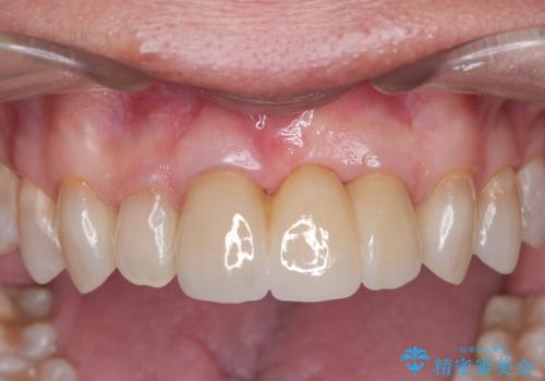 [ 欠損部の著しい骨欠損 ]　歯ぐきのボリュームを回復し自然なブリッジ作製治療の治療後