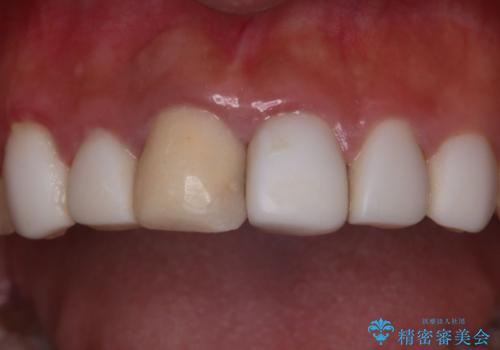 【オールセラミッククラウン】歯の色を合わせたい