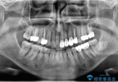 全ての銀歯を外すメタルフリー治療 + 歯並びをきれいにする矯正治療の治療後
