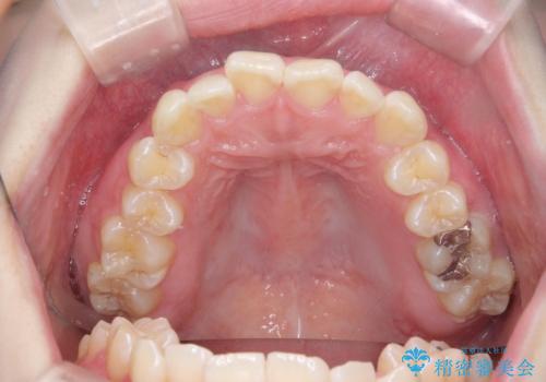 [ インビザラインライト ]  短期間で行う前歯のマウスピース治療の治療前