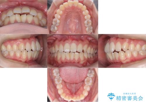 【ワイヤー矯正】前歯の突出感、下の歯の並びを良くしたいの治療前