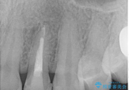 歯に食べ物がはさまる 色も揃えたい オールセラミックで治療の治療前