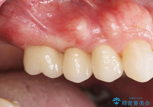 過大な力で折れた失活歯 セラミックブリッジ治療の治療後