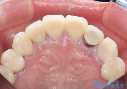 保険適応 硬質レジン前装冠から審美的でオールセラミッククラウンへの治療後