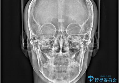 デコボコも深いかみ合わせも…“全部気になる”を一気に解決の治療前