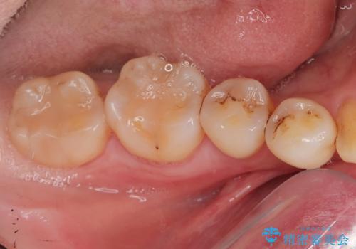 親知らず抜きたい。の治療前