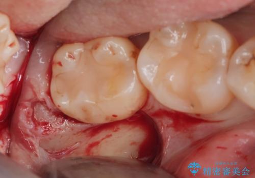 親知らず抜きたい。の治療中