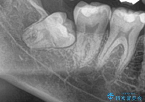 親知らずを抜きたい 親知らず抜歯の治療前