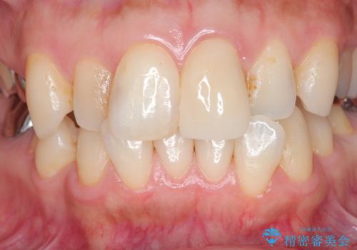 転んで折れた前歯セラミック治療で審美改善の治療後