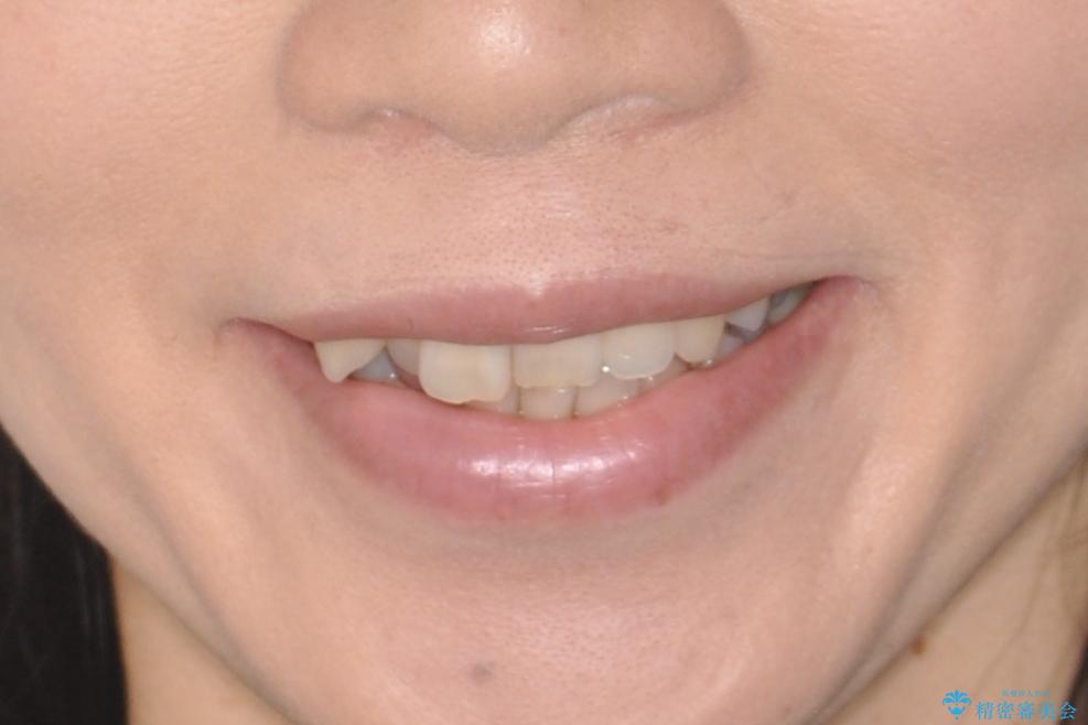 目立たないマウスピースで八重歯を解消。右上5番の抜歯スペースを活用したインビザライン矯正の治療前(顔貌)