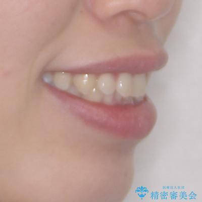 口ゴボが気になる 上下4本の抜歯矯正の治療前(顔貌)