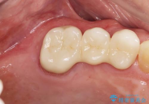 過大な力で折れた失活歯 セラミックブリッジ治療の治療後