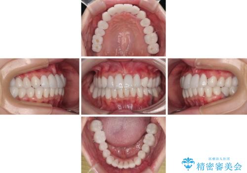 かかりつけ医の治療方針に疑問　歯周病治療と矯正治療を合わせた総合歯科治療の治療後