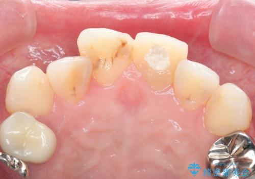 転んで折れた前歯セラミック治療で審美改善の治療中