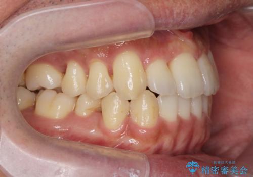 [ インビザライン矯正 ]  マウスピースで治す、すきっ歯　がたつきの治療後