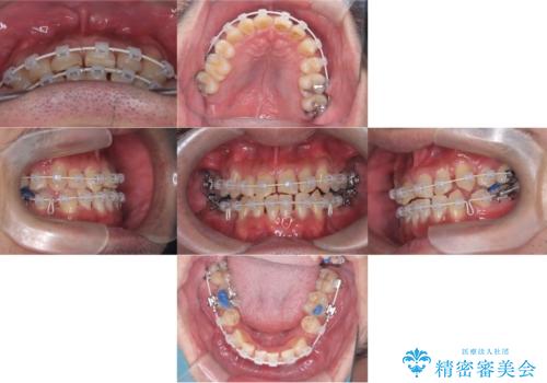 【ワイヤー矯正】かみ合わせを治したいの治療中